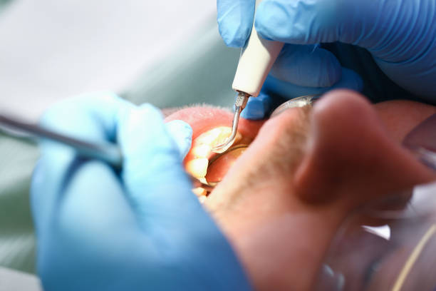 Best Emergency Root Canal Treatment in Somerville, NJ